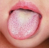 Кандидоз (молочница) полости рта - лечение