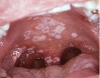Молочница во рту у взрослых: симптомы, лечение